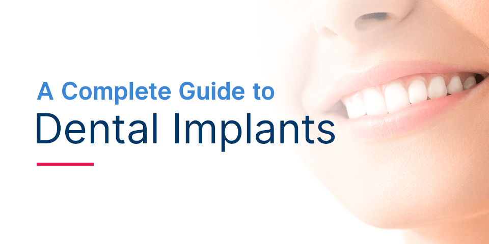 A complete guide to dental implants