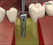 Narrow Ridge Implant