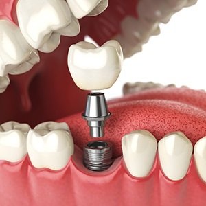 immediate load dental implant