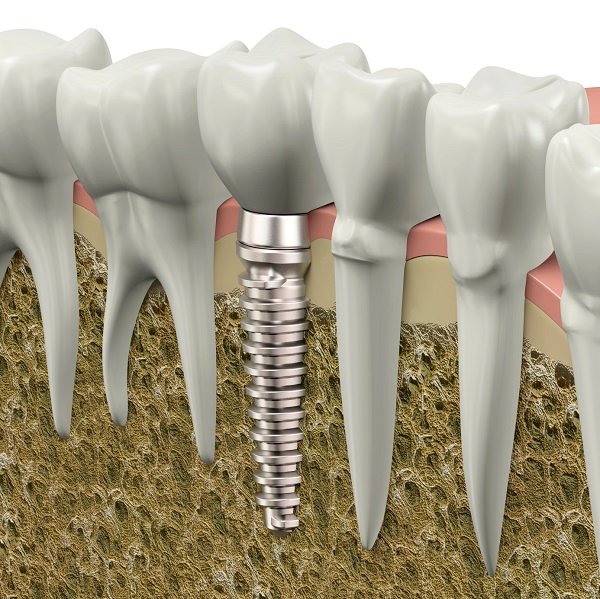 Dental implant in bone