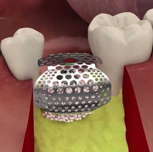 Titanium Mesh for Bone Regeneration